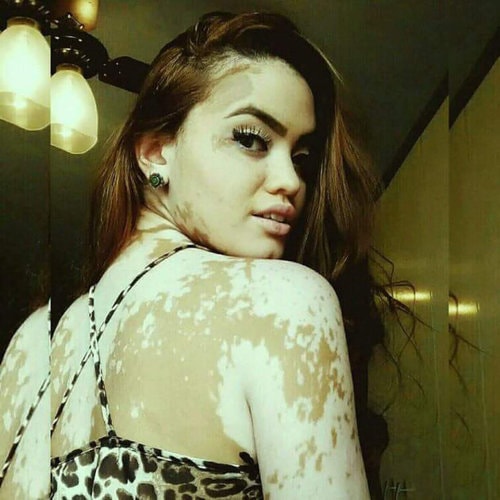 Here We Describes the Vitiligo Skin Disorder and its Treatment with Natural Herbal Ways