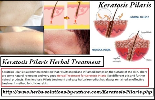 Keratosis Pilaris Herbal Treatment Suggestion for Effected People - Herbs Solutions By Nature