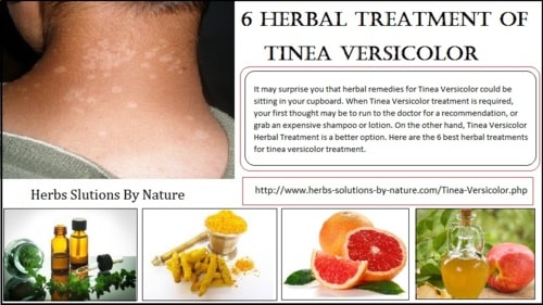 6 Herbal Treatment of Tinea Versicolor - Herbs Solutions By Nature