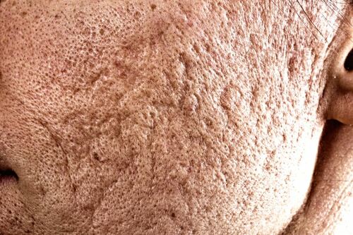 25% TCA Peel and Dermabrasion Significantly Improves Acne Scar Appearance - AnewSkin Aesthetic Clinic and Medical Spa